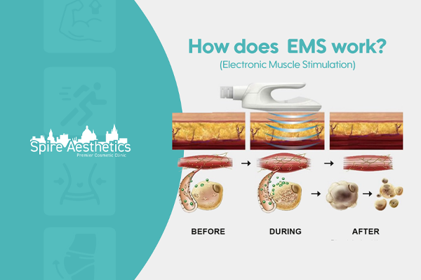 EMS treatment for post pregnancy weight loss treatment Finchampstead