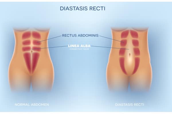 What Non-Surgical Options Are Available for Diastasis Recti Finchampstead?