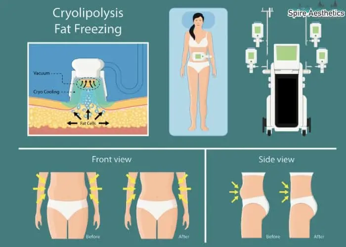 Fat freezing treatment Finchampstead benefits for competitions to remove stubborn fat deposits.