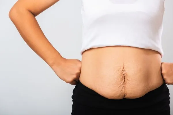 Image of a woman's stomach after weight loss with sagging skin following a gastric band Finchampstead
