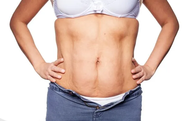 sagging skin on woman's stomach after weight loss injections Finchampstead