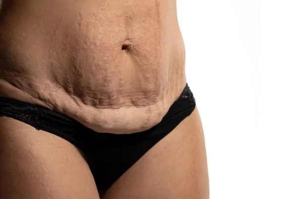 Image of womans stomach after weight loss injections Finchampstead showing saggy skin