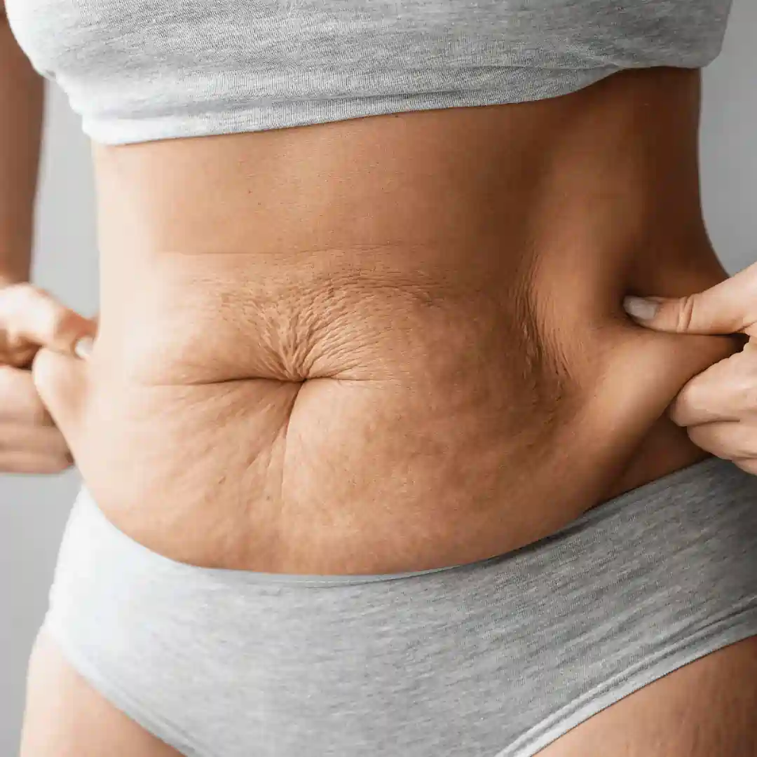 Is It Normal to Have Loose Skin After Pregnancy Finchampstead?