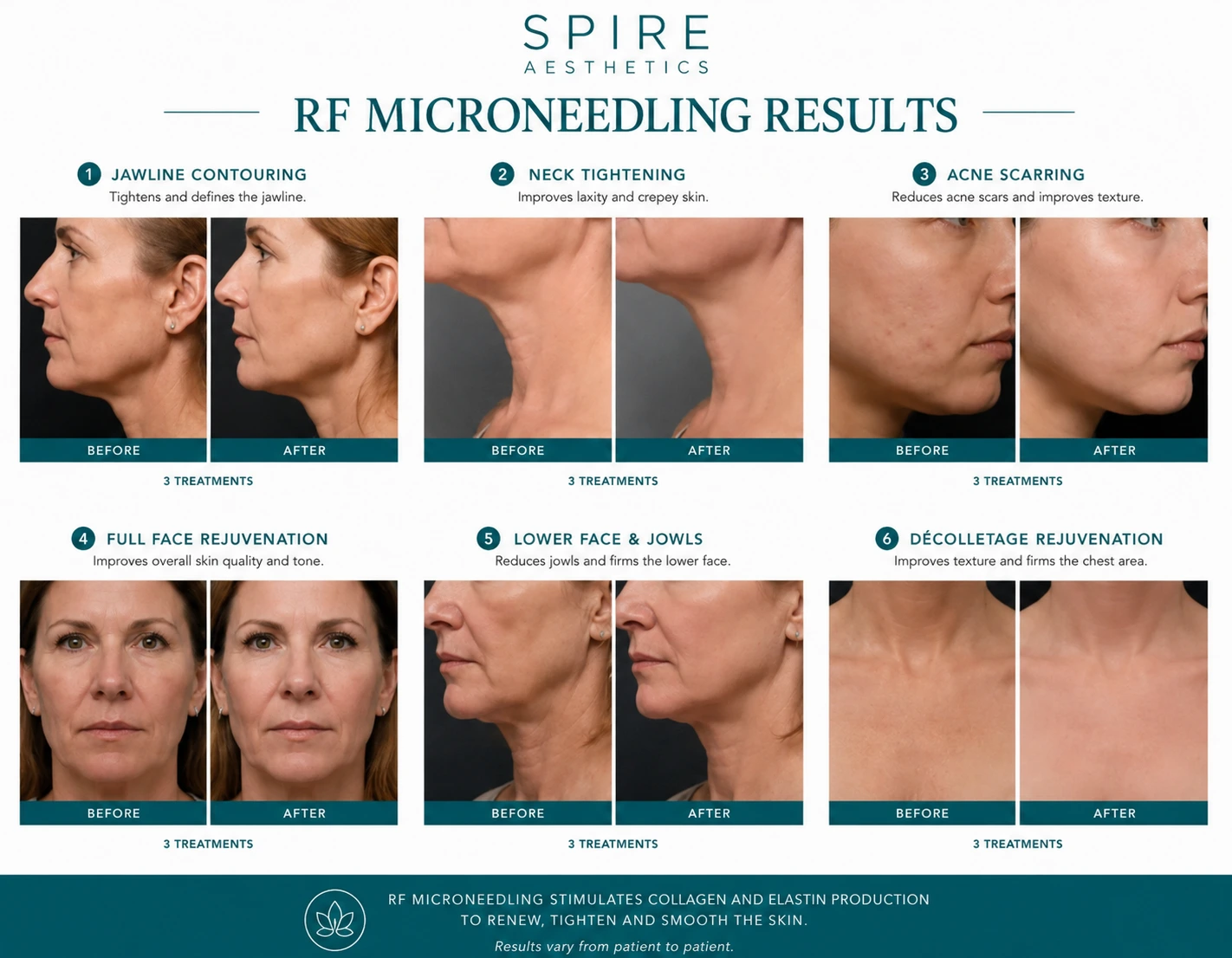 RF Microneedling Skin tightening Finchampstead results