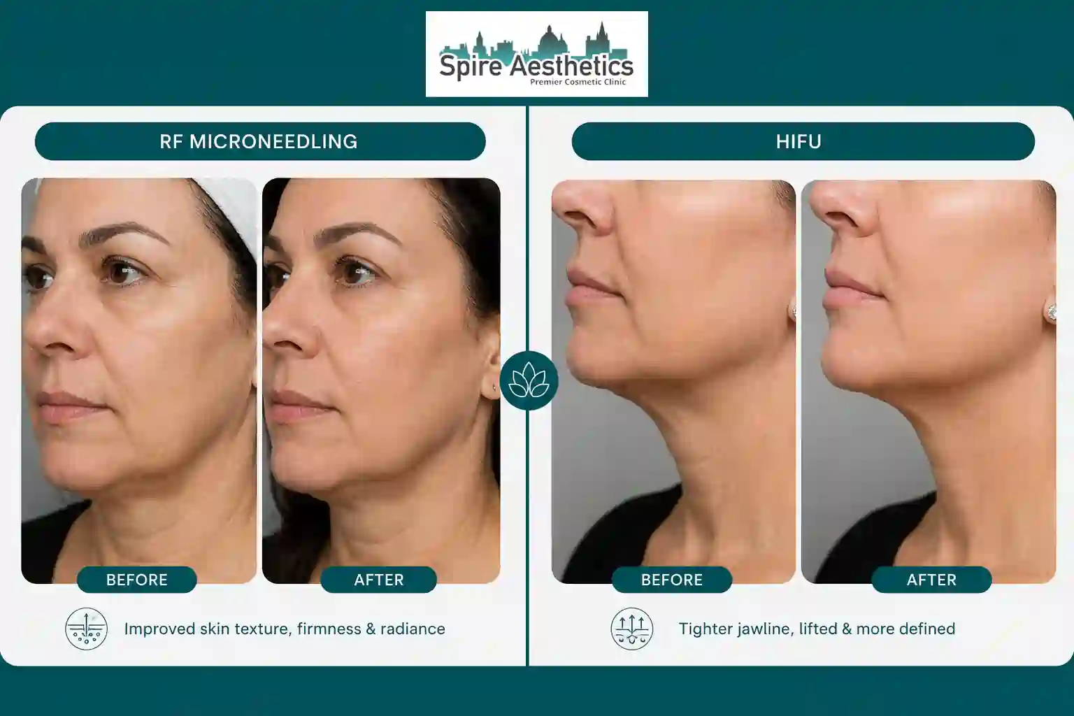 Can RF Microneedling and HIFU Be Combined Finchampstead?