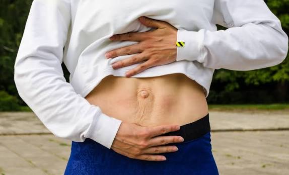 When Could Diastasis Recti Be the Missing Piece of the Puzzle Finchampstead?