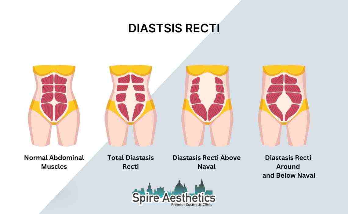 Is Non-Surgical Diastasis Recti Treatment Right for You? Common Concerns Answered Finchampstead